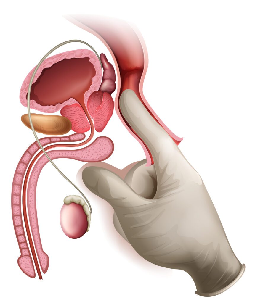 Laser Prostate Surgery