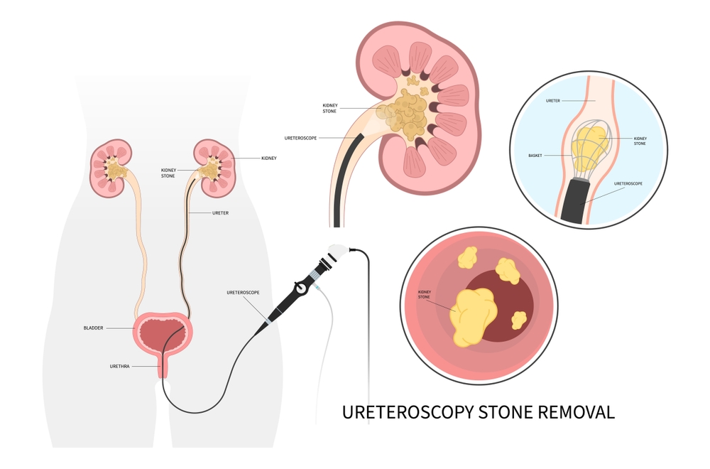 Endoscopic Kidney Stone Surgery in Ahilya Nagar
