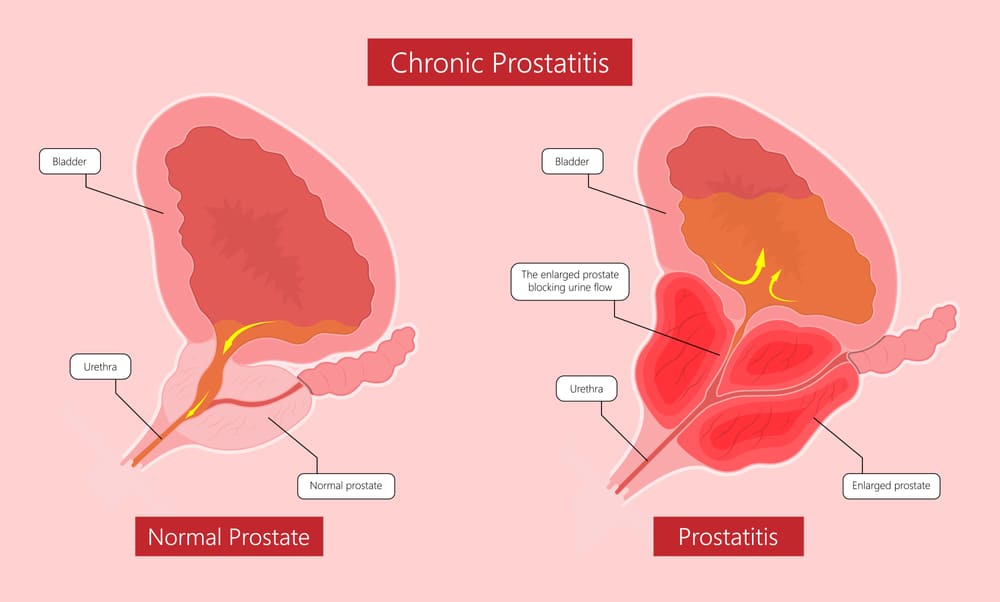Prostate Surgery in Ahilyanagar / Ahmednagar